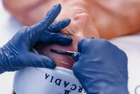 Dermaplaning